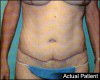 Tummy Tuck Patient