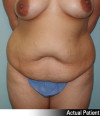 Tummy Tuck Patient