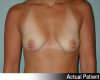 Breast Augmentation Patient