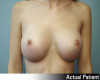 Breast Augmentation Patient