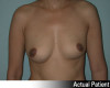 Breast Augmentation Patient