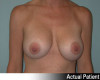 Breast Augmentation Patient