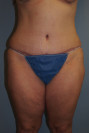 Tummy Tuck Patient