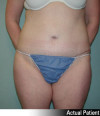 Tummy Tuck Patient