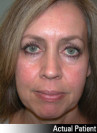 Eyelid Lift - Blepharoplasty Patient