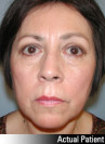 Eyelid Lift - Blepharoplasty Patient