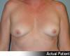 Breast Augmentation Patient