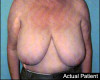 Breast Reduction Patient