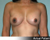 Breast Augmentation Patient