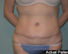 Tummy Tuck Patient