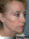 Neck Lift Patient