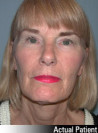 Facelift Patient