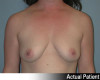 Breast Augmentation Patient