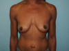 Breast Augmentation Patient