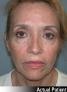 Facelift Patient