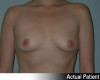 Breast Augmentation Patient