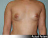 Breast Augmentation Patient