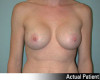 Breast Augmentation Patient