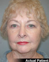 Facelift Patient