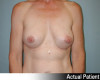 Breast Augmentation Patient