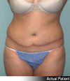 Tummy Tuck Patient