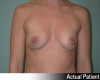 Breast Augmentation Patient