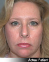 Eyelid Lift - Blepharoplasty Patient