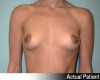 Breast Augmentation Patient