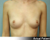 Breast Augmentation Patient