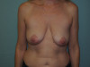 Breast Augmentation Patient