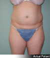 Liposuction Patient