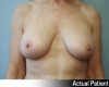 Breast Augmentation Patient