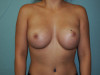 Breast Augmentation Patient