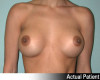 Breast Augmentation Patient