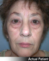 Eyelid Lift - Blepharoplasty Patient