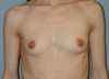 Breast Augmentation Patient