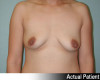 Breast Augmentation Patient