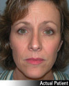 Brow Lift Patient