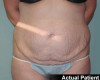 Tummy Tuck Patient