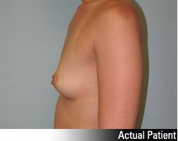 Patient # 52757 Before Photo # 5