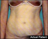 Tummy Tuck Patient