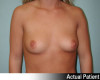 Breast Augmentation Patient