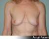 Breast Augmentation Patient