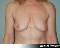 Patient # 23237 Before Photo # 1