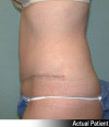 Tummy Tuck Patient