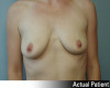 Breast Augmentation Patient