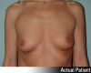 Breast Augmentation Patient