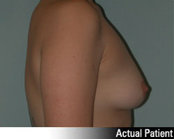 Patient # 94238 Before Photo # 5