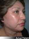 Face Lift and Neck Lift Patient