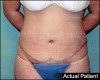 Tummy Tuck Patient